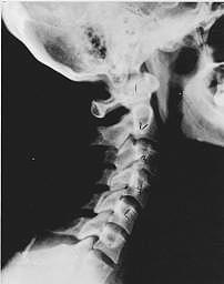 Subluxation Degeneration - Normal